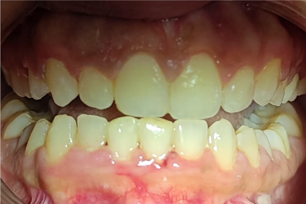 After aligner treatment: an even, neatly aligned arch