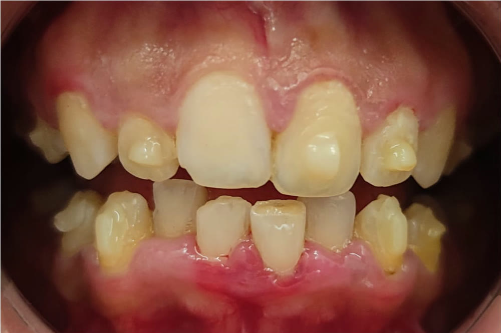 Before aligner treatment: severely crowded and rotated teeth with uneven gaps