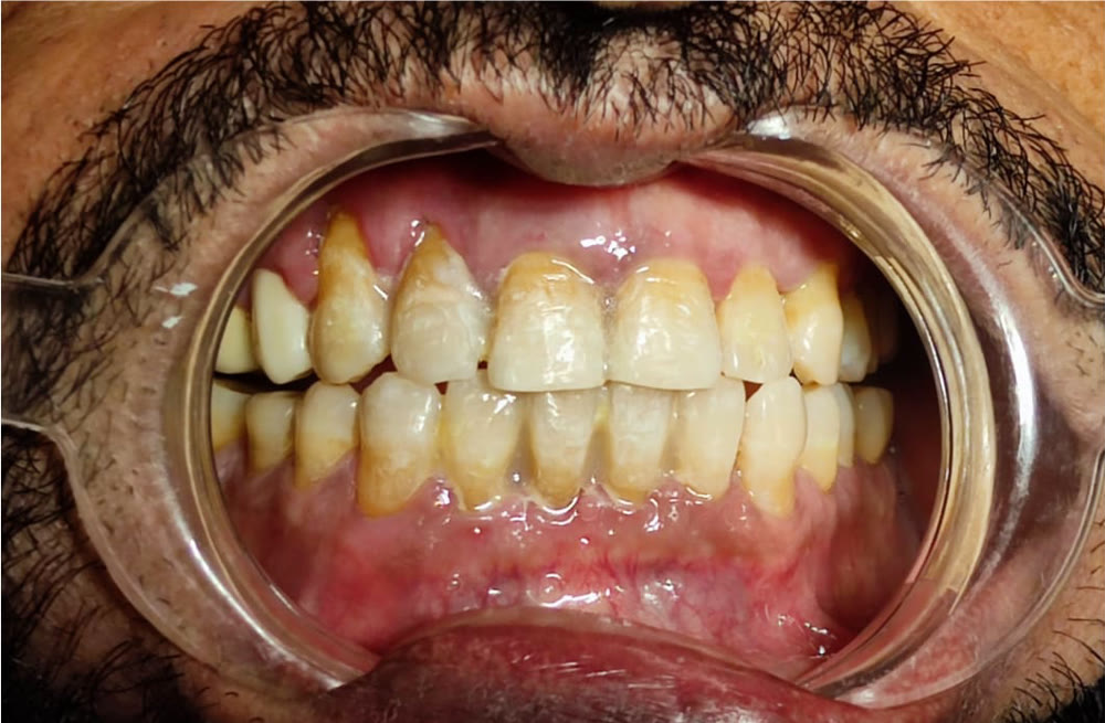 After aligner treatment: gaps closed with an even, settled bite