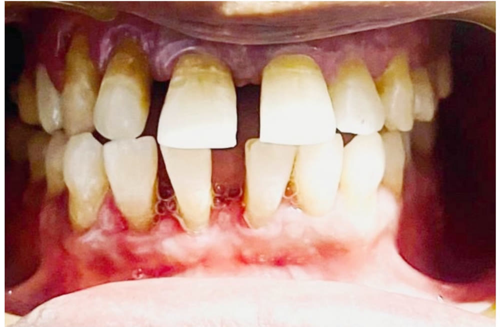Before aligner treatment: noticeable gaps and flared front teeth