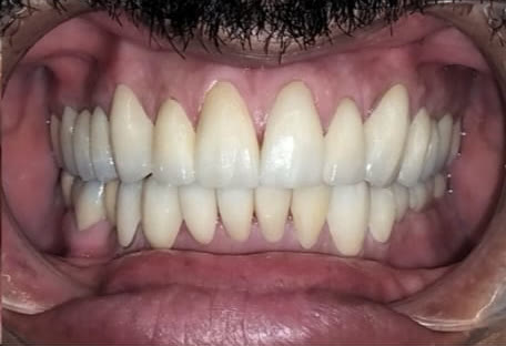 After: front view showing a fully rebuilt, even and natural-looking set of teeth