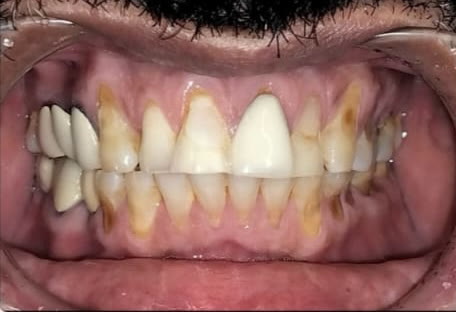 Before: front view showing worn, stained and eroded upper and lower teeth