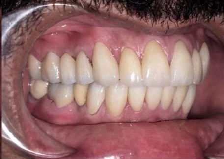 After: left side view showing an even, fully restored dentition