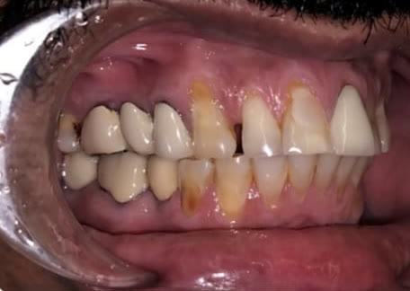 Before: left side view showing worn down teeth and gaps