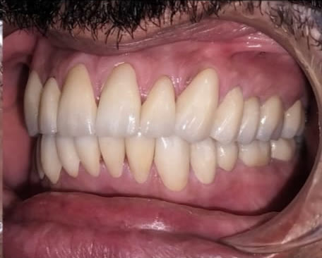 After: right side view showing the rebuilt bite with restored tooth height