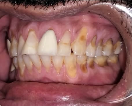Before: right side view showing severe erosion and decay along the back teeth