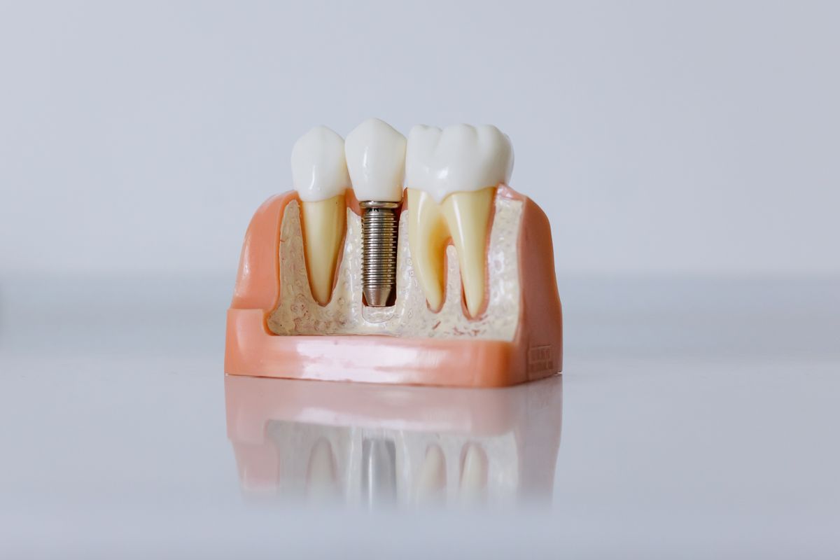 Dental implant model showing how an implant anchors a replacement tooth