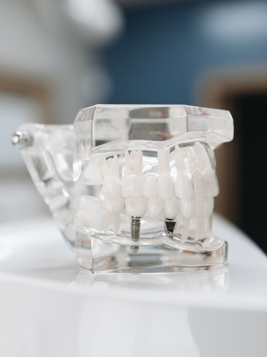 A transparent dental model showing how a titanium implant anchors a replacement tooth